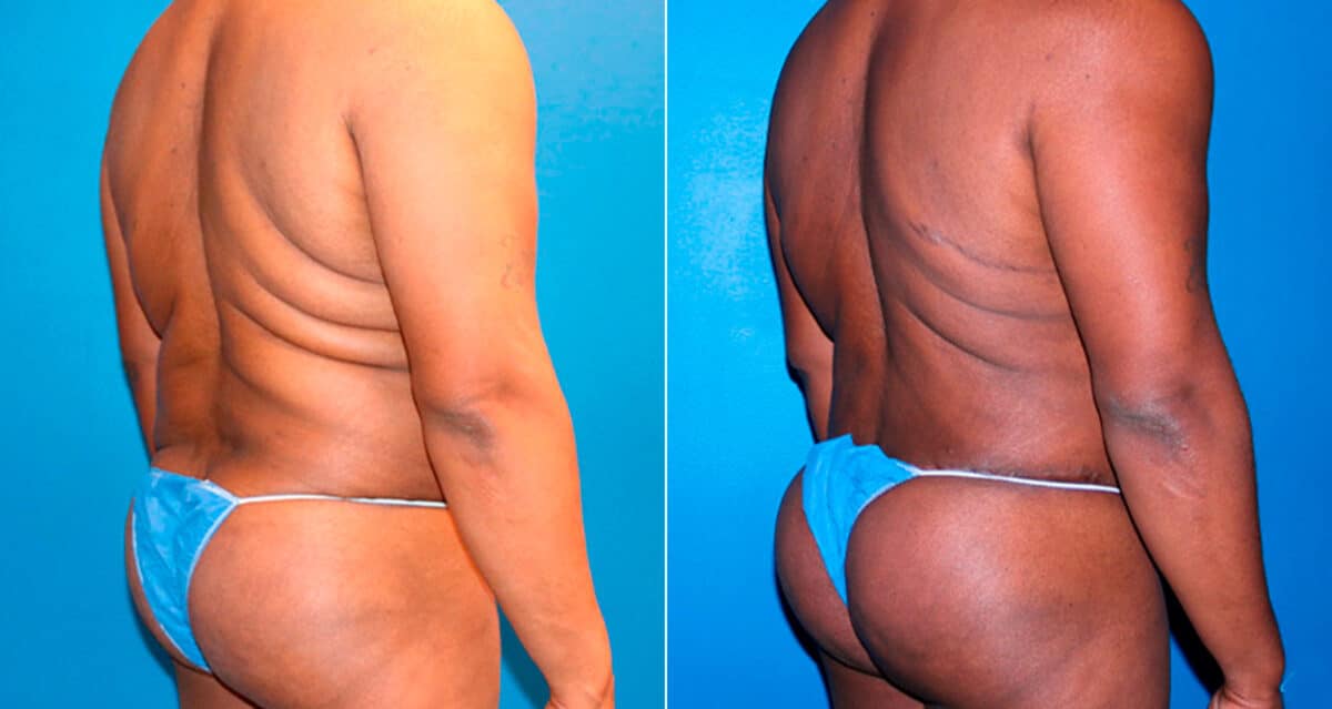 Body Banking Before and After Photos in New York, NY, Patient 17276