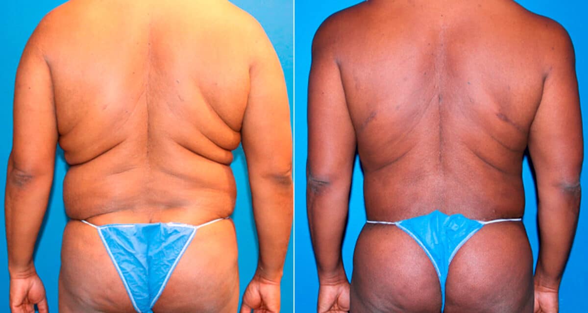 Body Banking Before and After Photos in New York, NY, Patient 17276