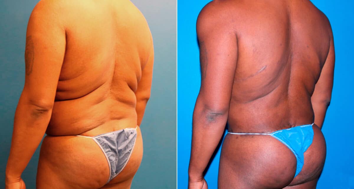 Body Banking Before and After Photos in New York, NY, Patient 17276