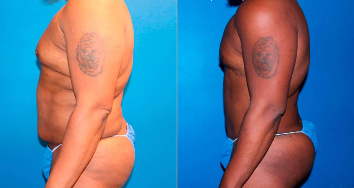 Body Banking Before and After Photos in New York, NY, Patient 17276