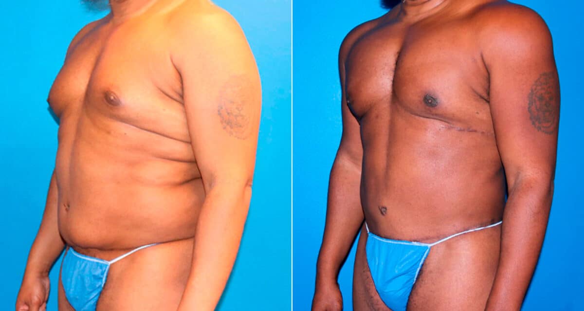 Body Banking Before and After Photos in New York, NY, Patient 17276