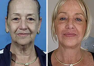 Facelift Before and After Photos in New York, NY, Patient 11341