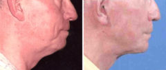 Facelift Before and After Photos in New York, NY, Patient 15631