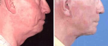 Facelift Before and After Photos in New York, NY, Patient 15631