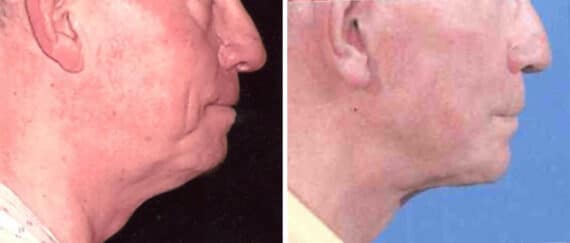 Facelift Before and After Photos in New York, NY, Patient 15631