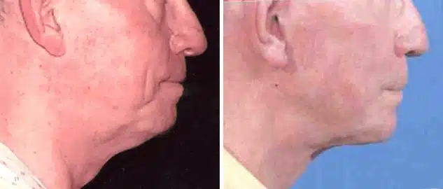 Facelift Before and After Photos in New York, NY, Patient 15631