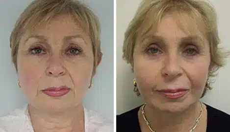 Facelift Before and After Photos in New York, NY, Patient 11350