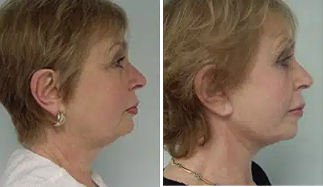 Facelift Before and After Photos in New York, NY, Patient 11350