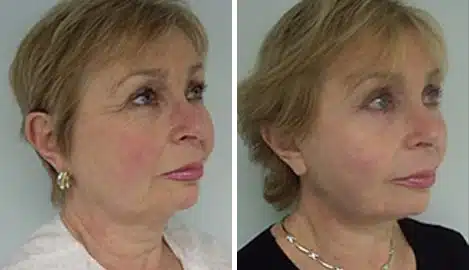 Facelift Before and After Photos in New York, NY, Patient 11350