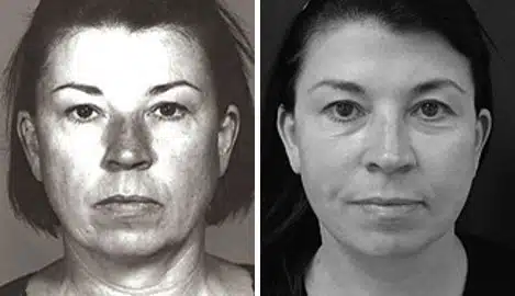 Facelift Before and After Photos in New York, NY, Patient 11346