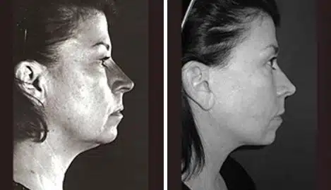 Patient 11346, Facelift Before and After Photos Facelift Before and After Photos in New York, NY, Patient 11346