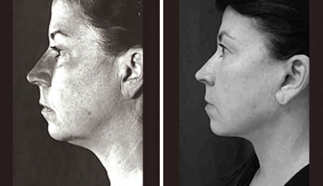 Patient 11346, Facelift Before and After Photos Facelift Before and After Photos in New York, NY, Patient 11346