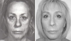 Facelift Before and After Photos in New York, NY, Patient 11343