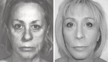 Facelift Before and After Photos in New York, NY, Patient 11343