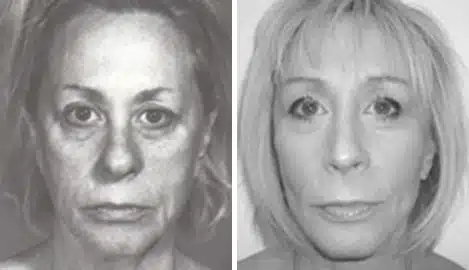 Facelift Before and After Photos in New York, NY, Patient 11343