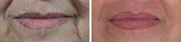 Lip Augmentation Before and After Photos in New York, NY, Patient 11407