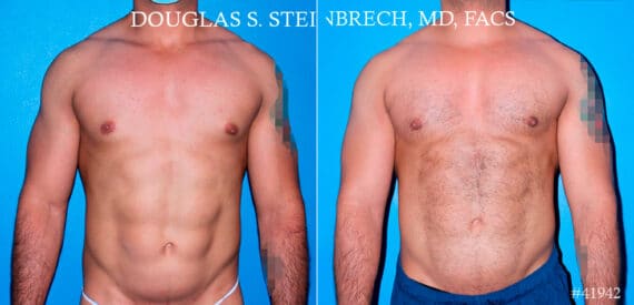 Pectoral Augmentation Before and After Photos in New York, NY, Patient 17373
