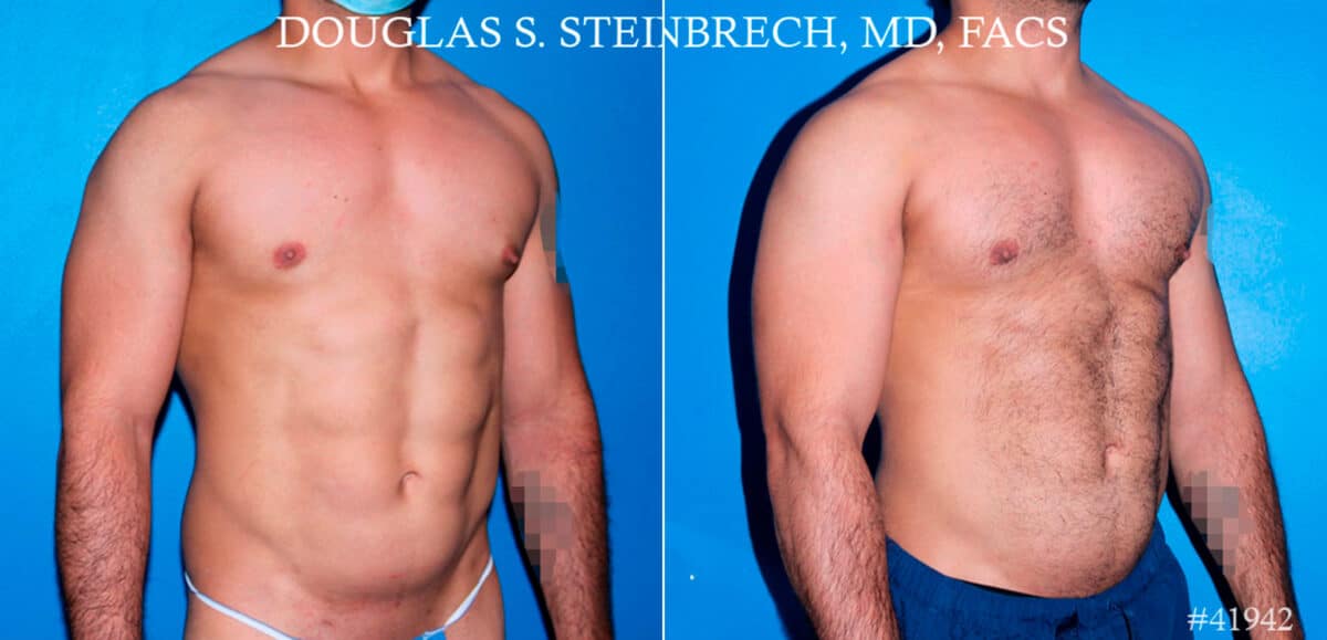 Pectoral Augmentation Before and After Photos in New York, NY, Patient 17373
