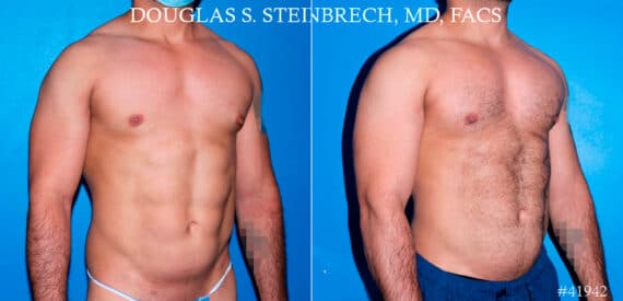 Pectoral Augmentation Before and After Photos in New York, NY, Patient 17373