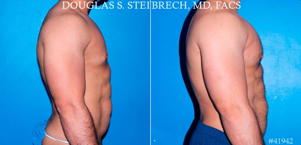 Pectoral Augmentation Before and After Photos in New York, NY, Patient 17373