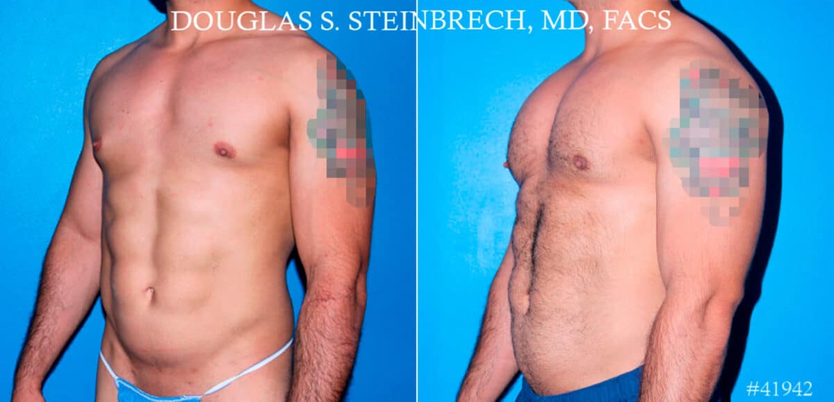 Pectoral Augmentation Before and After Photos in New York, NY, Patient 17373
