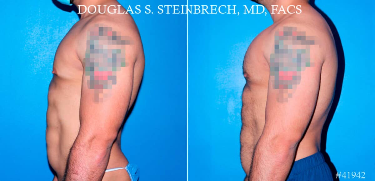 Pectoral Augmentation Before and After Photos in New York, NY, Patient 17373
