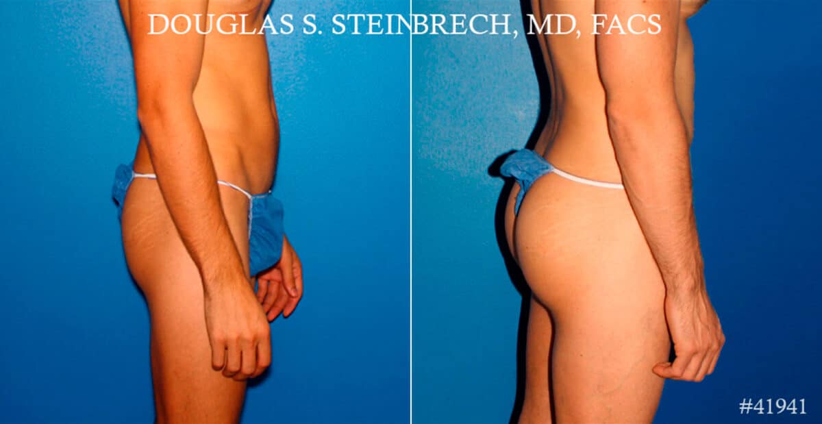 Gluteal Augmentation Before and After Photos in New York, NY, Patient 17414