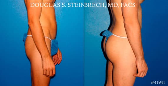 Gluteal Augmentation Before and After Photos in New York, NY, Patient 17414