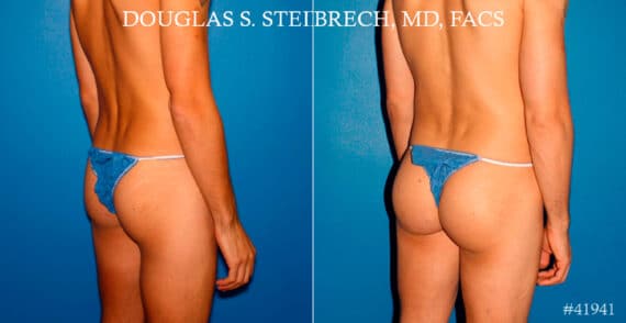 Gluteal Augmentation Before and After Photos in New York, NY, Patient 17414
