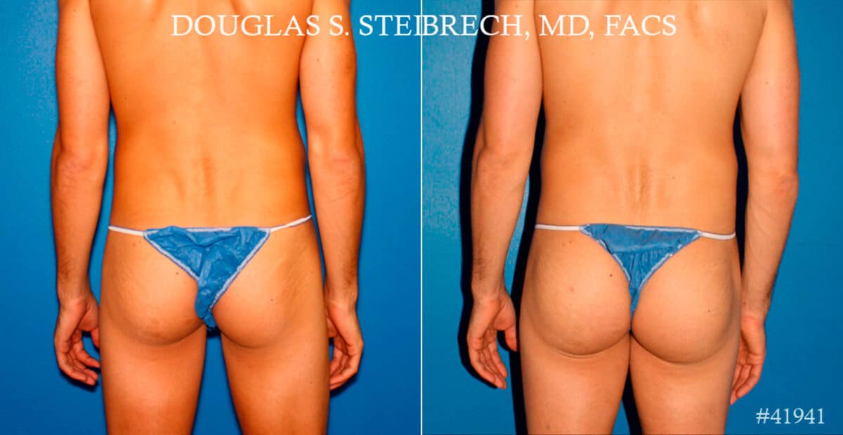 Gluteal Augmentation Before and After Photos in New York, NY, Patient 17414