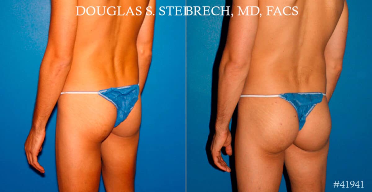Gluteal Augmentation Before and After Photos in New York, NY, Patient 17414