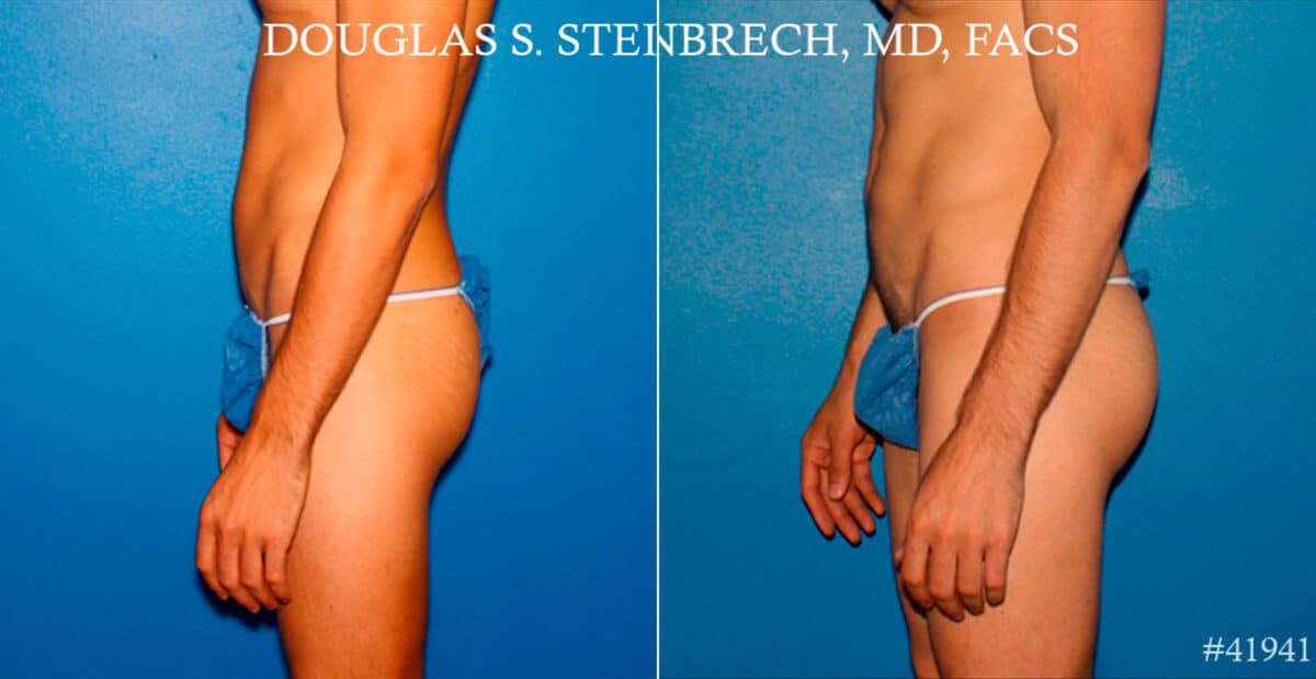 Gluteal Augmentation Before and After Photos in New York, NY, Patient 17414
