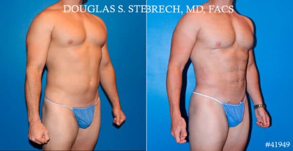 Body Banking Before and After Photos in CA, Beverly Hills, Patient 17750