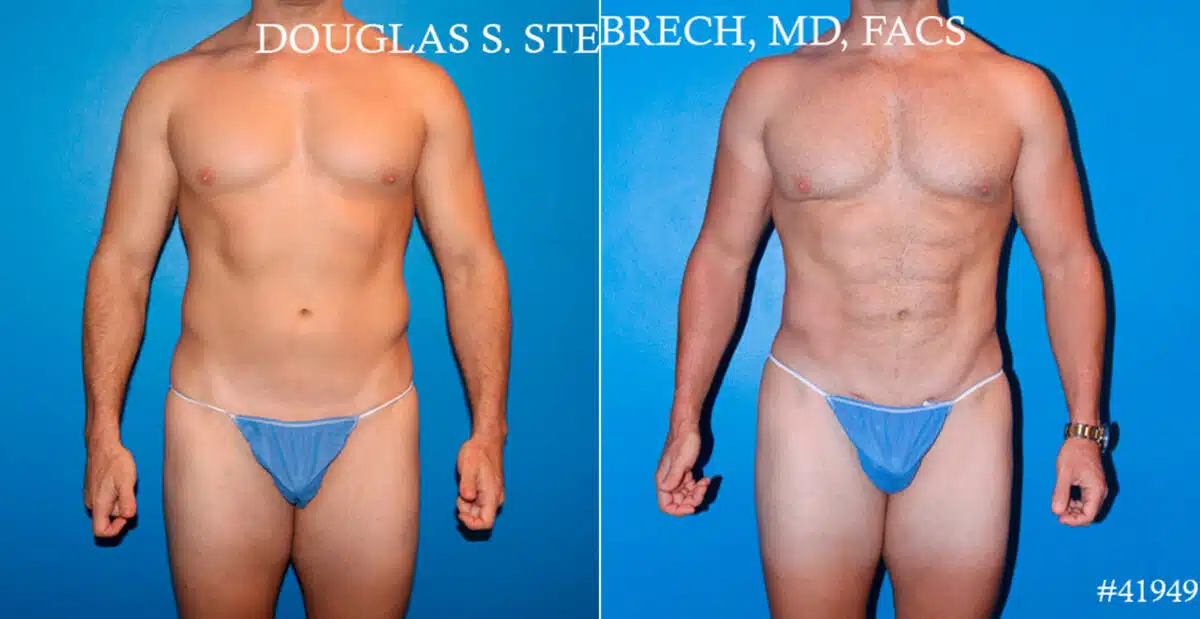 Body Banking Before and After Photos in CA, Beverly Hills, Patient 17750