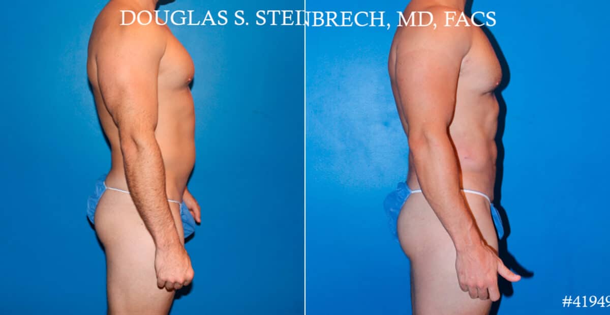 Body Banking Before and After Photos in CA, Beverly Hills, Patient 17750