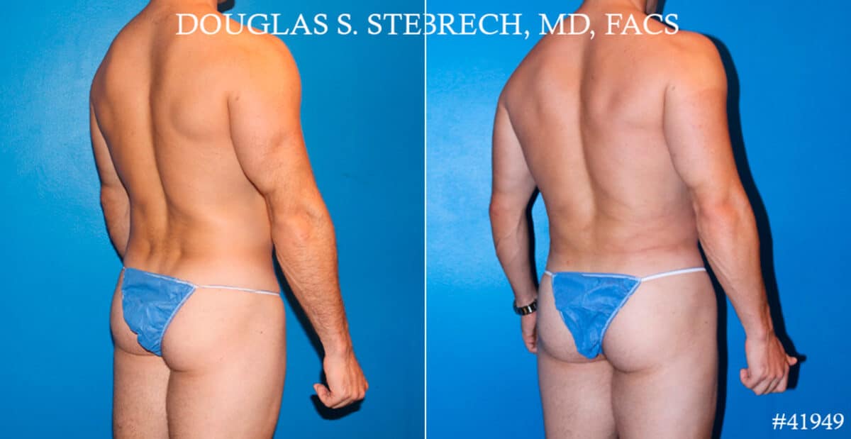 Body Banking Before and After Photos in CA, Beverly Hills, Patient 17750