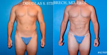 Body Banking Before and After Photos in CA, Beverly Hills, Patient 17750
