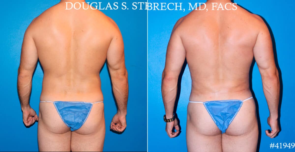 Body Banking Before and After Photos in CA, Beverly Hills, Patient 17750