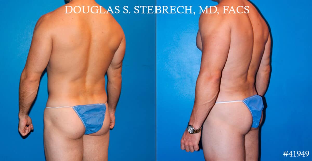 Body Banking Before and After Photos in CA, Beverly Hills, Patient 17750
