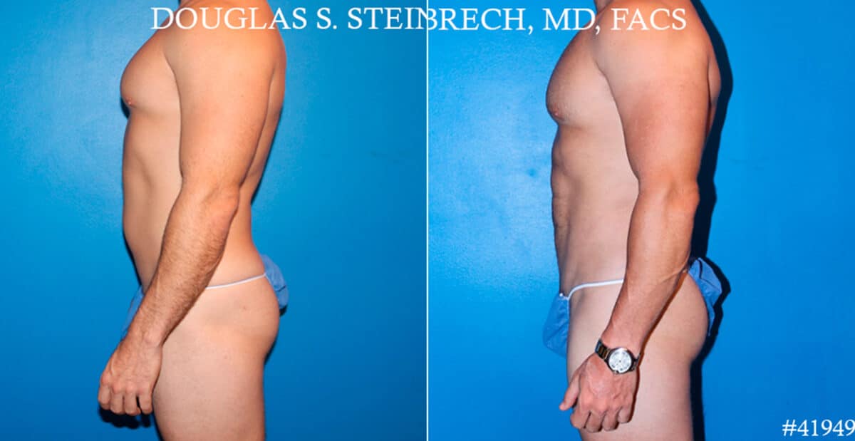 Body Banking Before and After Photos in CA, Beverly Hills, Patient 17750