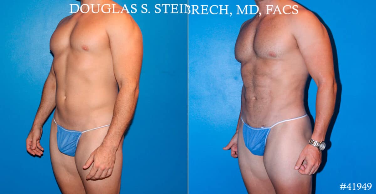 Body Banking Before and After Photos in CA, Beverly Hills, Patient 17750