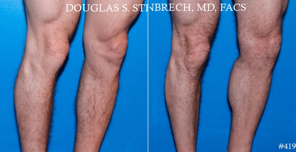 Calf Implants Before and After Photos in CA, Beverly Hills, Patient 17775