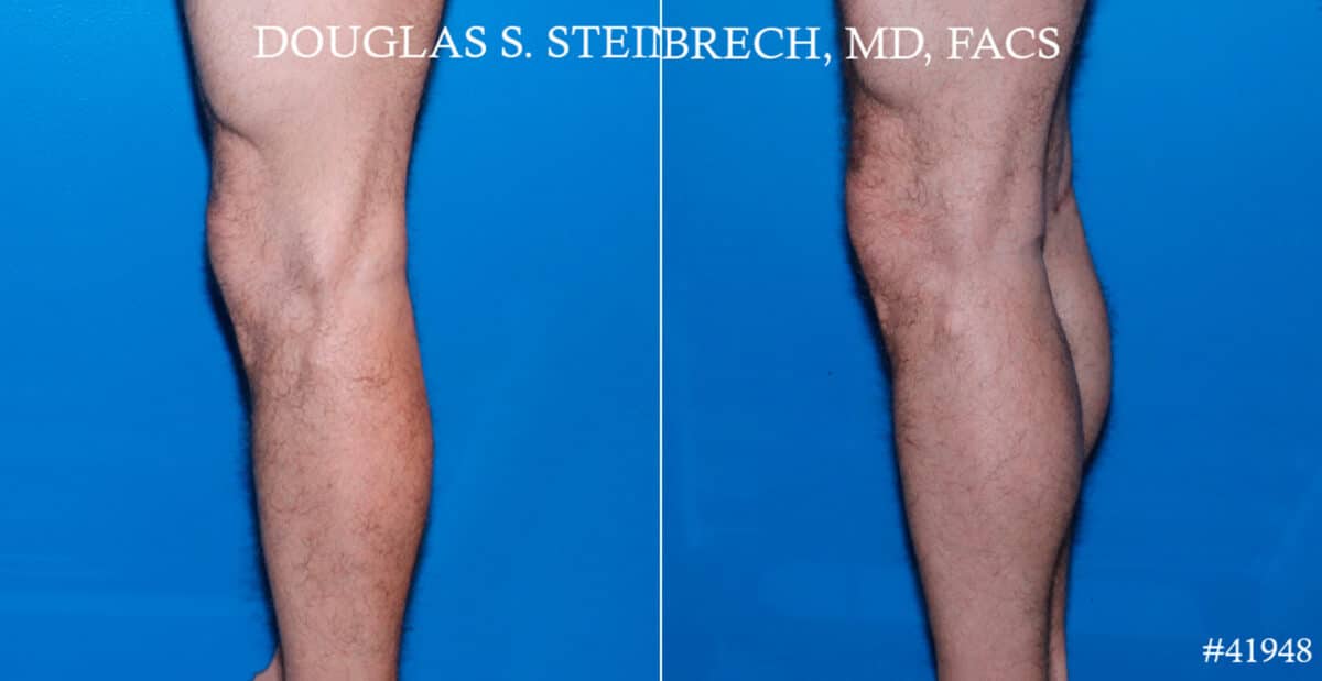 Calf Implants Before and After Photos in CA, Beverly Hills, Patient 17775