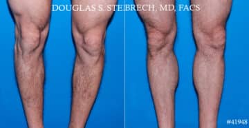 Calf Implants Before and After Photos in CA, Beverly Hills, Patient 17775