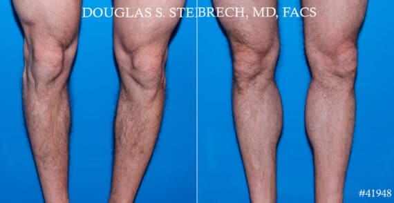 Calf Implants Before and After Photos in CA, Beverly Hills, Patient 17775