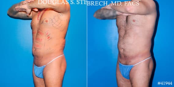 Body Banking Before and After Photos in CA, Beverly Hills, Patient 17802
