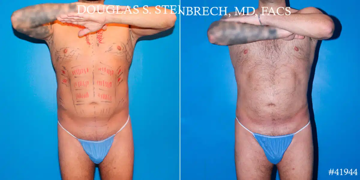 Body Banking Before and After Photos in CA, Beverly Hills, Patient 17802