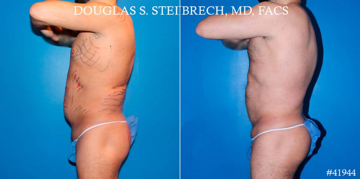 Body Banking Before and After Photos in CA, Beverly Hills, Patient 17802