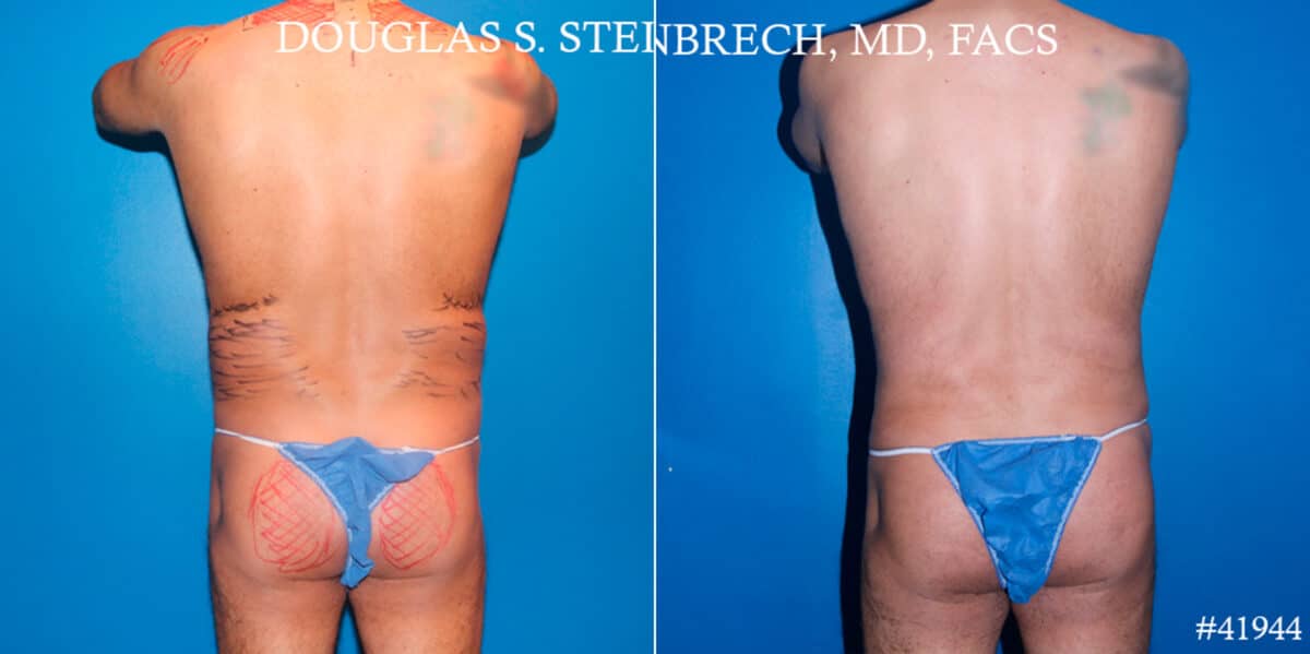 Body Banking Before and After Photos in CA, Beverly Hills, Patient 17802