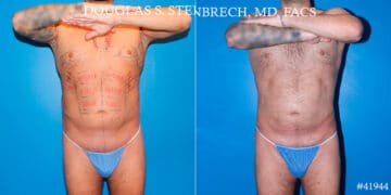 Body Banking Before and After Photos in CA, Beverly Hills, Patient 17802